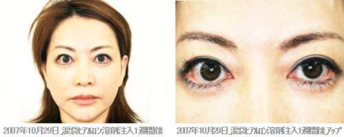 プラセンタ注射 中村うさぎvsマッド髙梨 ガチblog ライブドアブログ