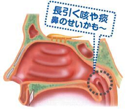 イラスト-後鼻漏