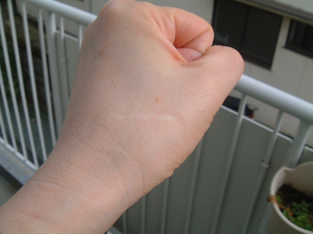根性焼きの瘢痕切除 Nobody Knows My Life With A Blind Cat