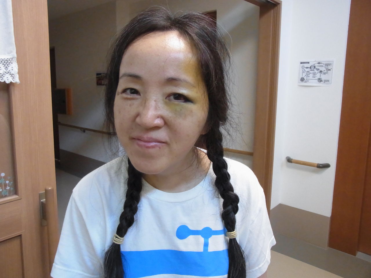 内出血 たんこぶ
