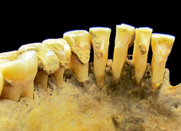 700年前の歯石はDNAの宝庫