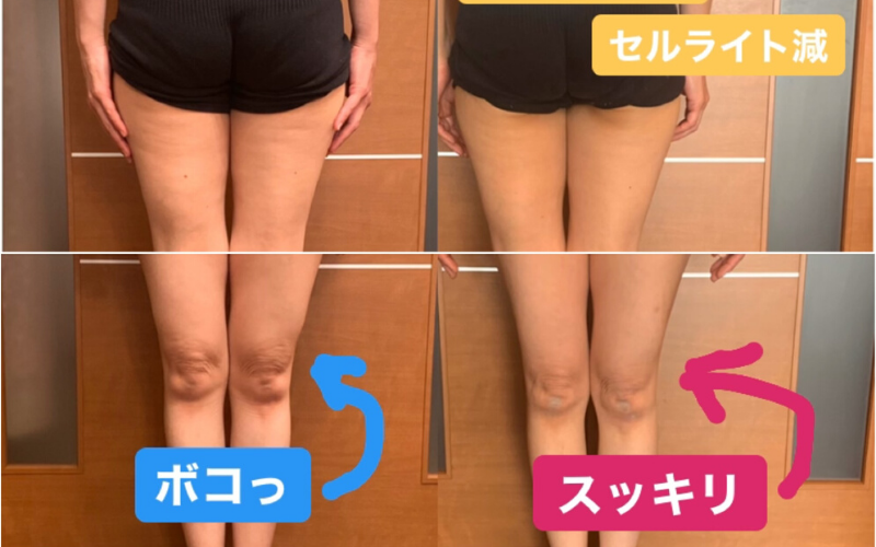 太ももにセルライトができる原因や仕組みは 撃退マッサージ法も必見 ろいアンテナ 太ももにセルライトができる原因や仕組みは 撃退マッサージ法も必見 ろいアンテナ