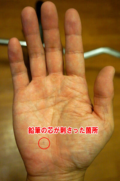 鉛筆が刺さってできた子ども時代の 黒い傷痕 今からきれいに治せる ろいアンテナ