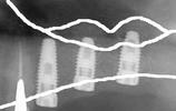 implant