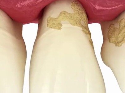 「抜けた歯をもう一度生やす」薬を大阪の病院が臨床試験「米国だと美容扱いで10倍取られる」【海外の反応】