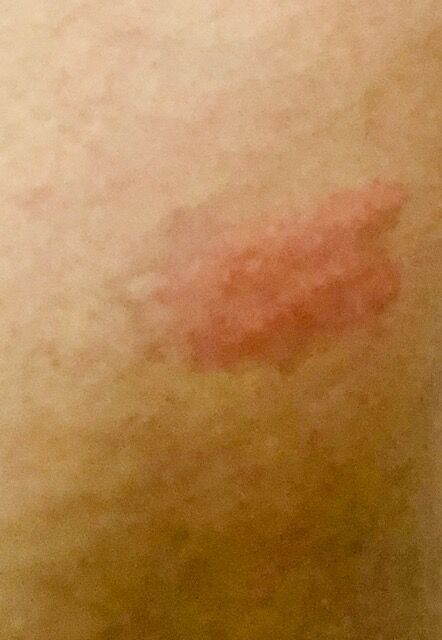 ダニに刺される Festina Lente