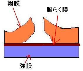 網膜に孔が開く2