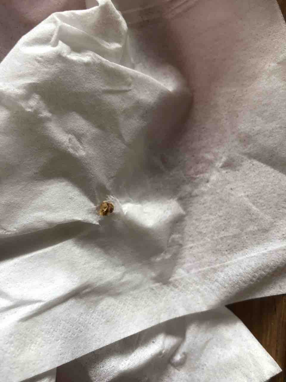 結石 痛み 管 止め 尿