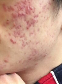 なんj 成人してもニキビ治らない部 それな速報