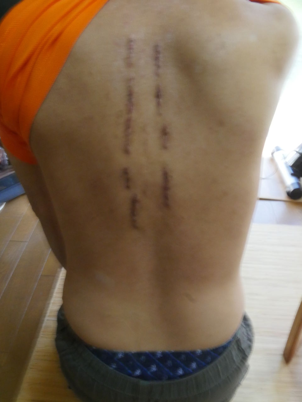 モトクロスによる背骨骨折の記録２ 再手術編 社会復帰編 Motocross Days