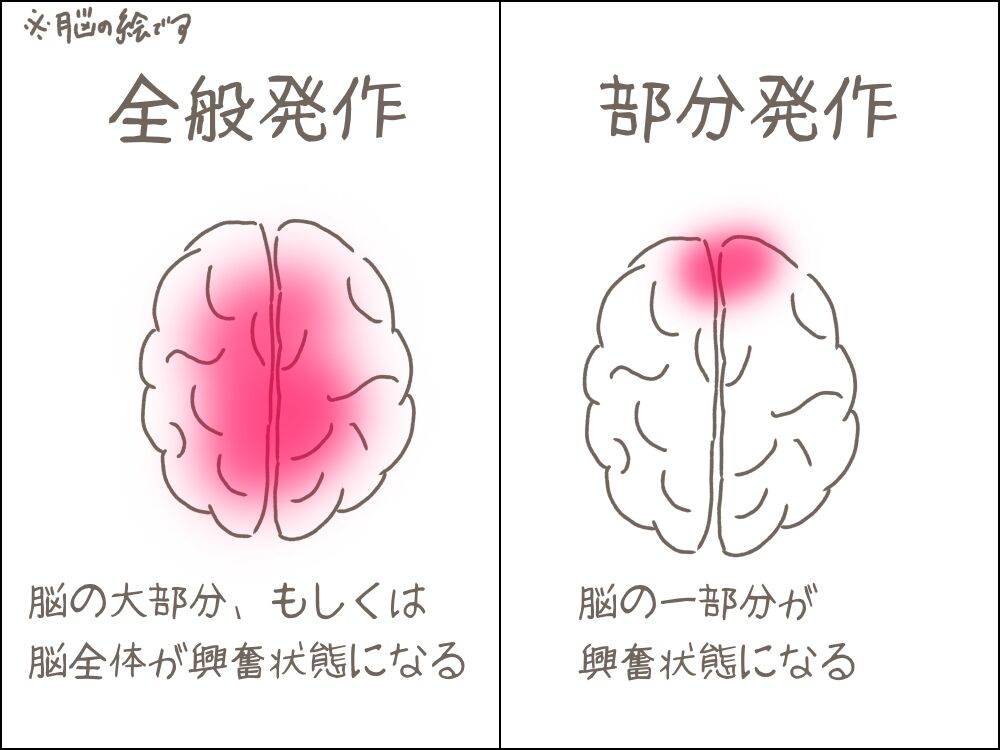 てんかん発作〜部分発作〜 : フツウに見える?〜アラサーてんかん女性の日常〜