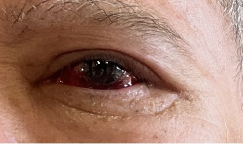 深い充血切り取り