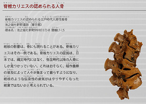 脊椎カリエス