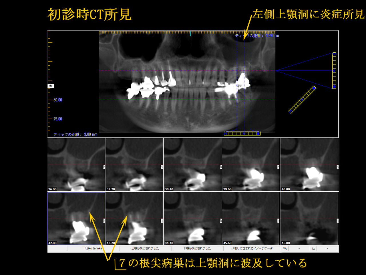 意図的歯牙再植による歯性上顎洞炎の治療例 : 布山歯科医院
