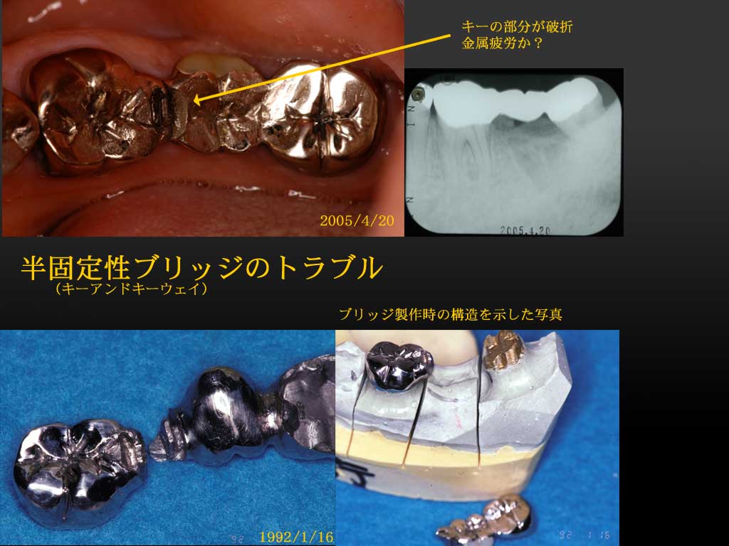 補綴物のトラブルを再考する2 布山歯科医院 補綴物のトラブルを再考する2 布山歯科医院