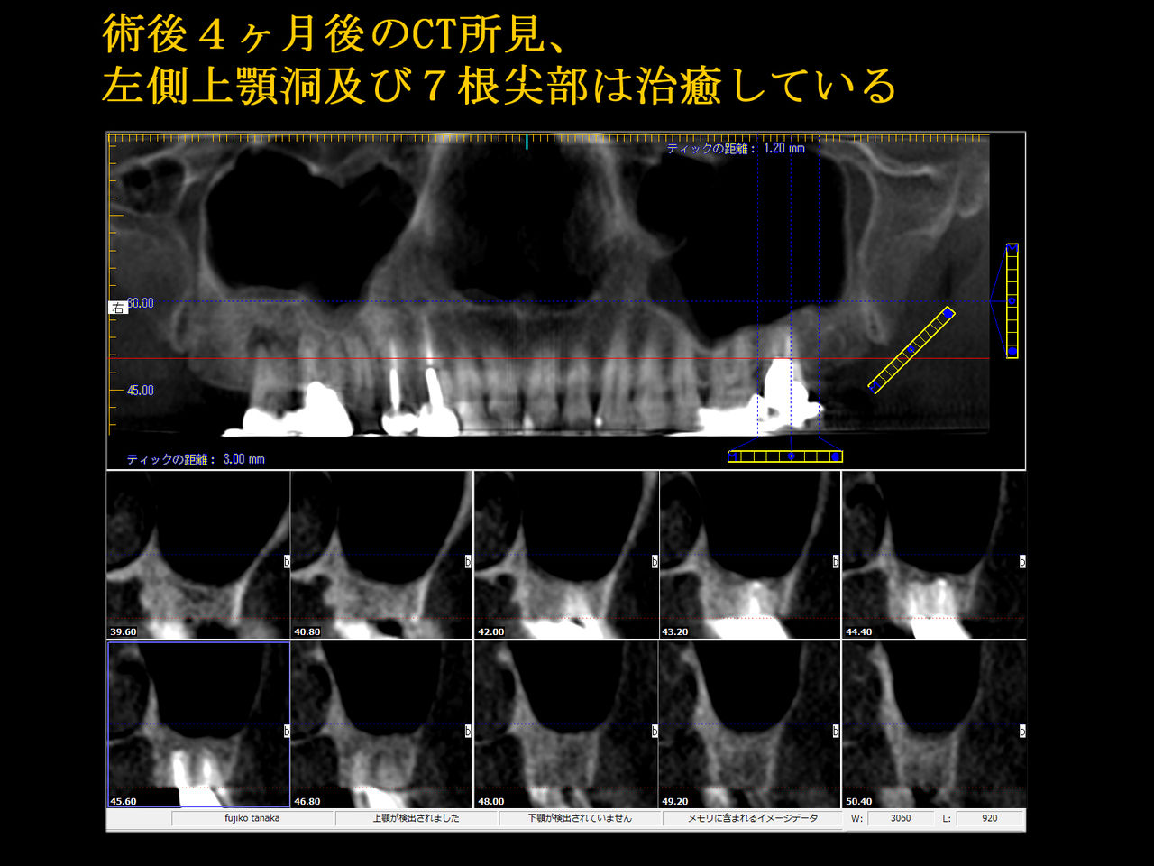 意図的歯牙再植による歯性上顎洞炎の治療例 布山歯科医院