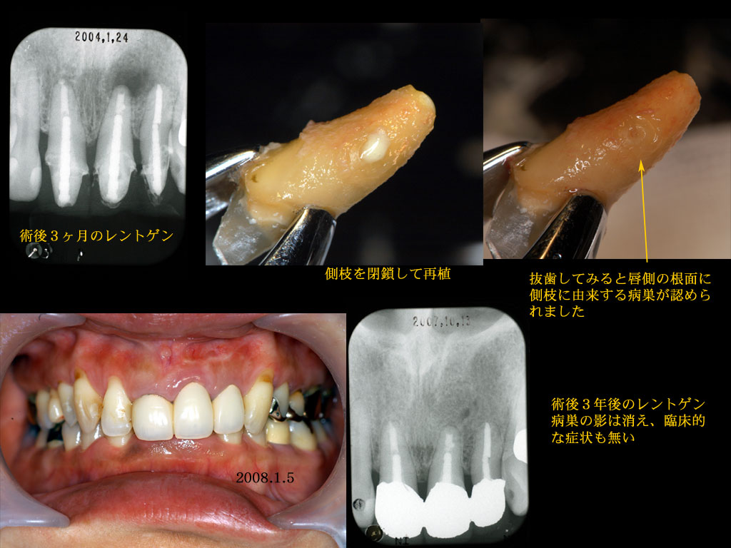根管治療の予後7 布山歯科医院