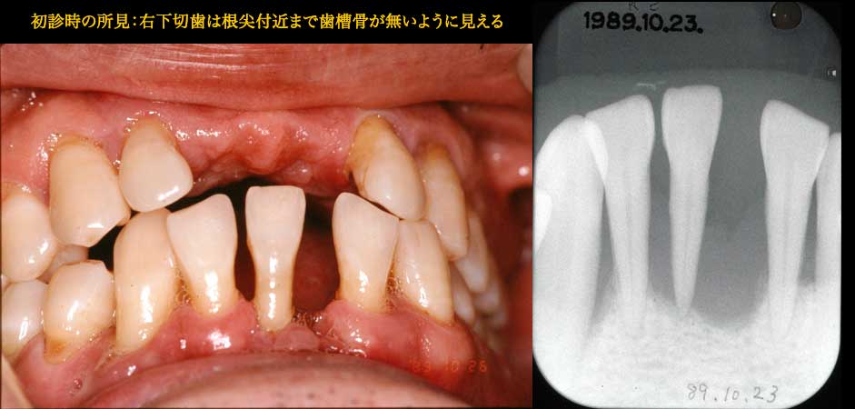 歯槽骨の再生 布山歯科医院