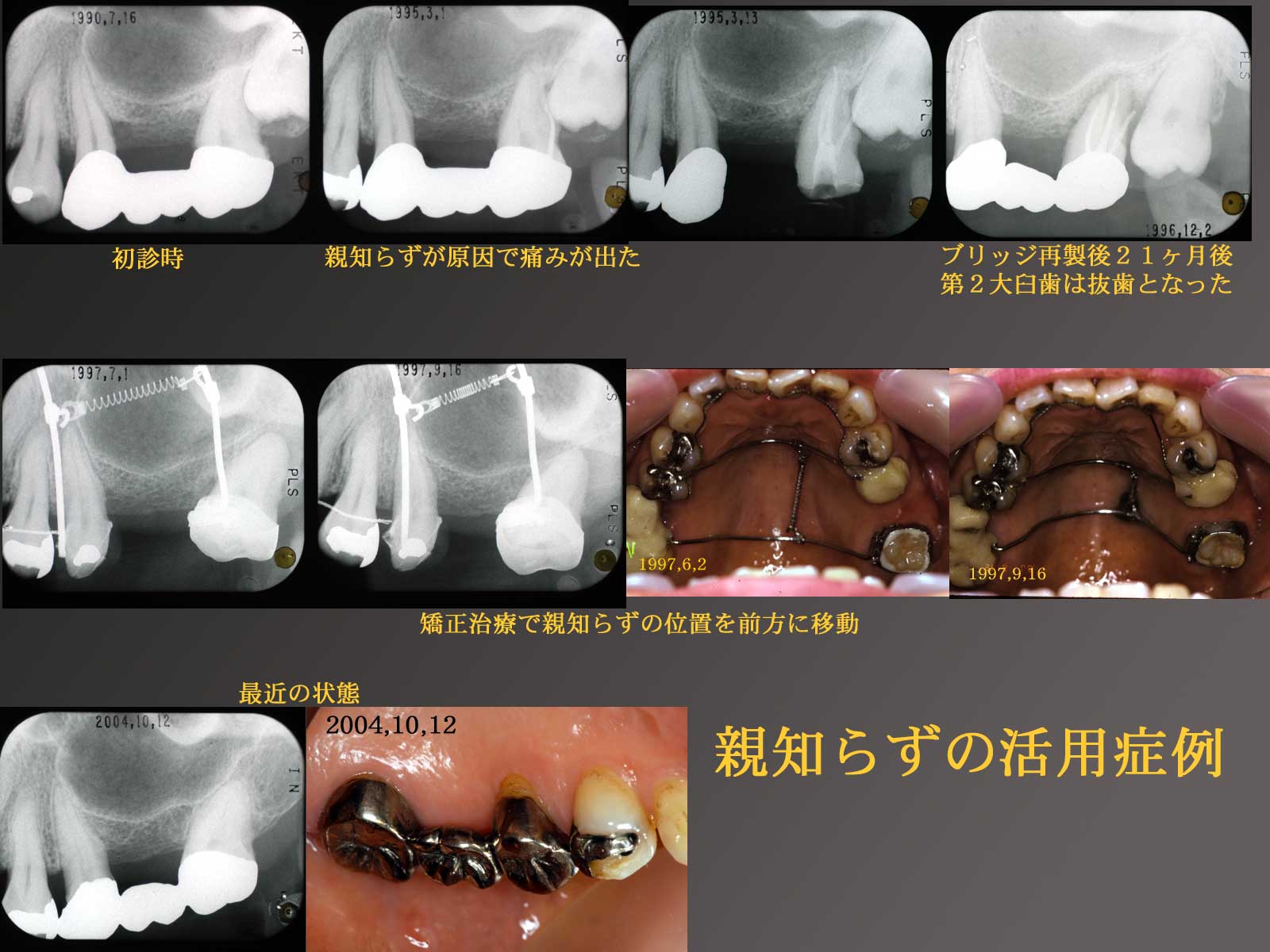 親知らず なん j