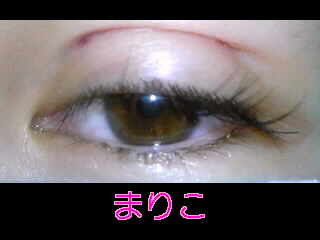 二日目 埋没法で二重整形