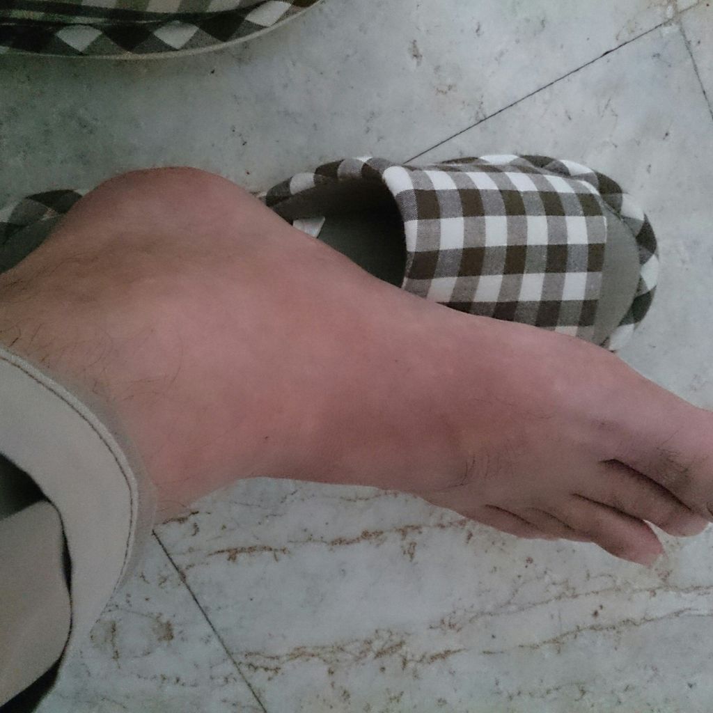 またまた痛風になる タイで思う