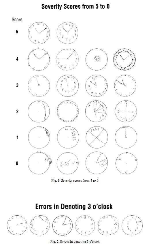 認知機能の低下前後での時計描画課題 Clock Drawing Test の変化に基づく その新たな採点法 Keep On Thinking