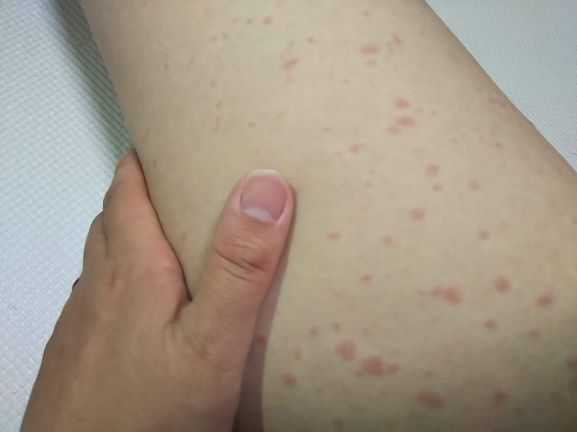 薬の副作用で皮膚がかゆくなる 赤いブツブツができる 放置してはいけない重症化する症状は adガールの夢 薬の副作用で皮膚がかゆくなる 赤いブツブツができる 放置してはいけない重症化する症状は adガールの夢
