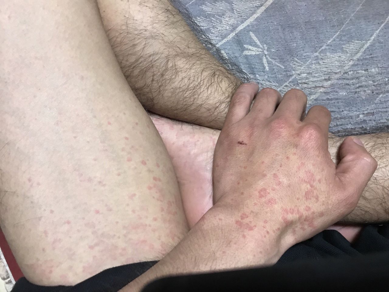 梅毒陽性反応でちゃいした ﾟdﾟ ａｄガールの夢