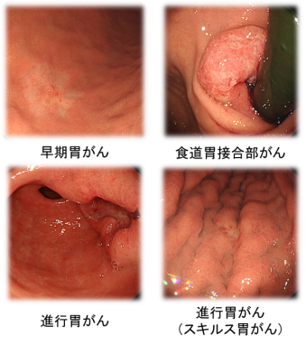 胃がん スキルス スキルス胃がんとは？症状・原因・検査・治療法 [胃がん]