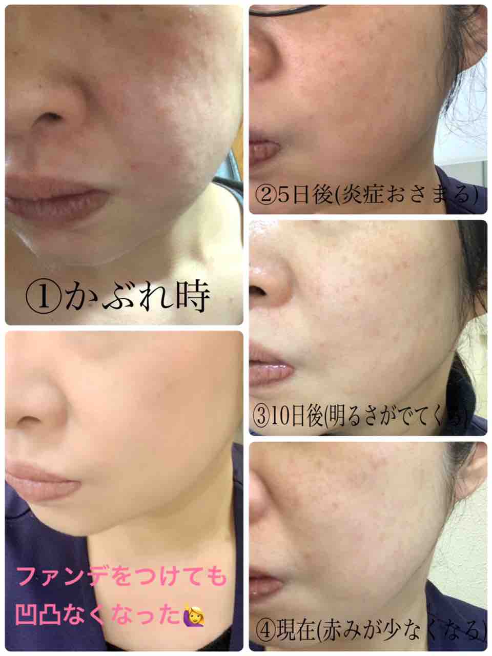 マスクで肌荒れ おこしてませんか マスクつけっぱなしでかぶれた女の肌荒れ改善日記 青森 弘前の化粧品店天香堂のブログ あなたのキレイ応援します マスクで肌荒れ おこしてませんか マスクつけっぱなしでかぶれた女の肌荒れ改善日記 青森 弘前の化粧品店天香堂のブログ あなたのキレイ応援します