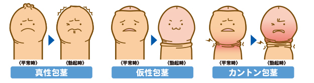 包茎手術 失敗 Tm Boyの海外1人歩きblog 包茎手術 失敗 Tm Boyの海外1人歩きblog