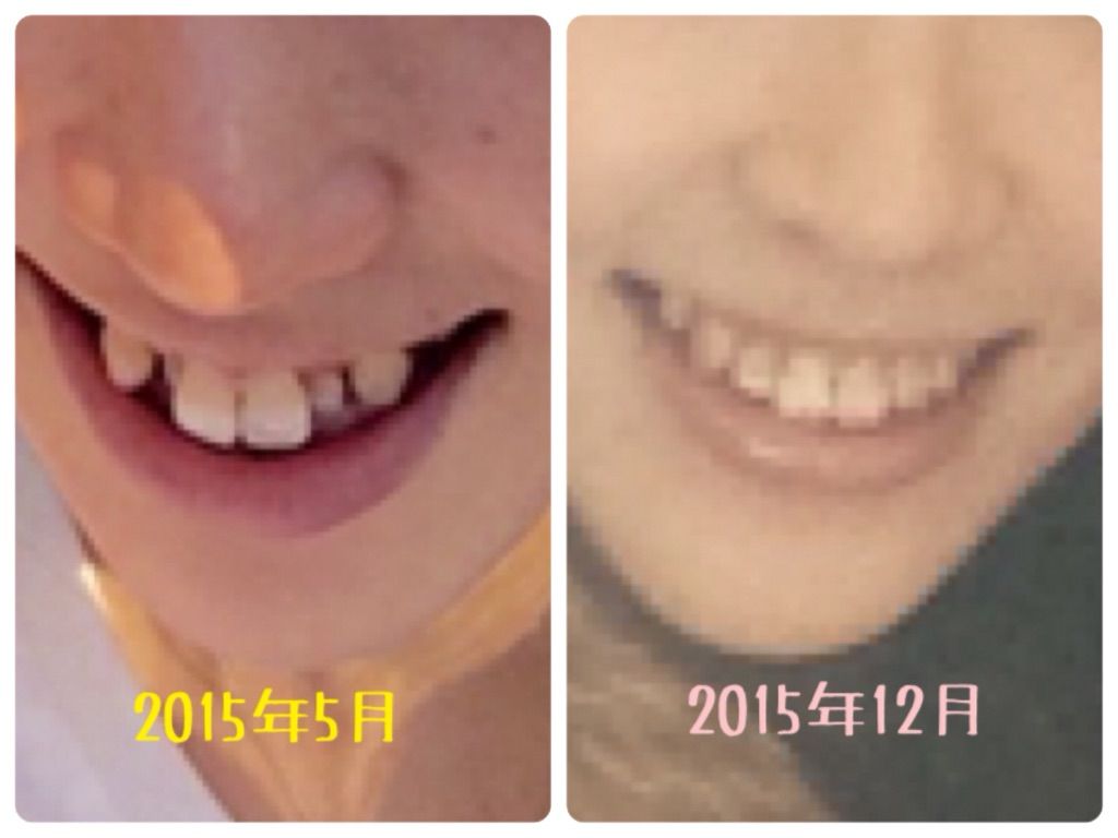 矯 顔の印象の変化 半年前との比較写真 33歳独身女 Kottaの歯列矯正やってるなう ブログ