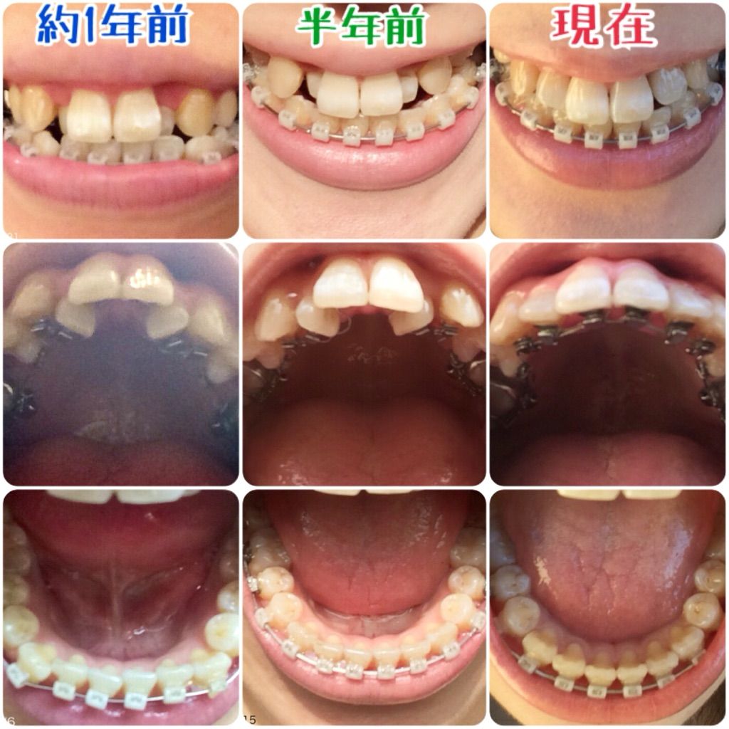 33歳独身女 Kottaの歯列矯正やってるなう ブログ