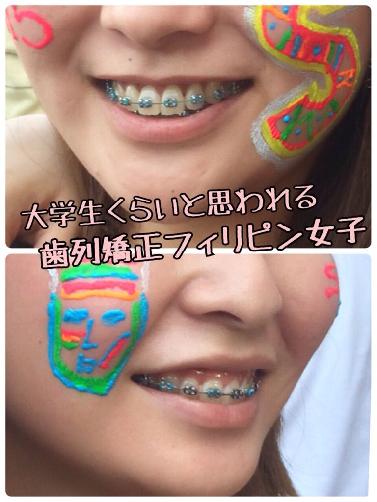 矯フ 12 歯列矯正60日目 比較画像たくさん その2 33歳独身女 Kottaの歯列矯正やってるなう ブログ