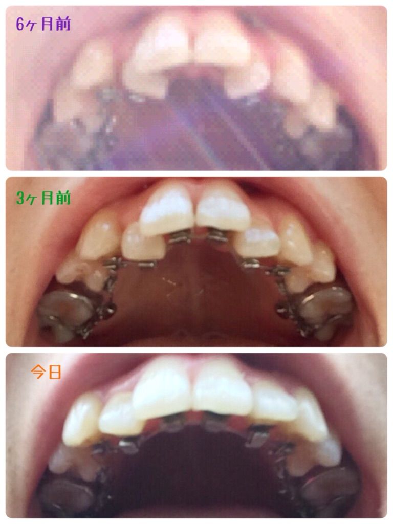 矯 80 上下左右からのここ半年の比較画像 33歳独身女 Kottaの歯列矯正やってるなう ブログ