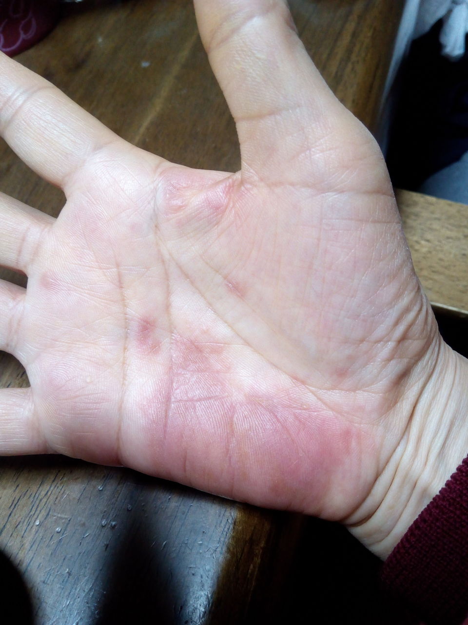 手の副作用は 一日中手袋で やや落ち着く とげまめ君の元気日記 肺転移 トリプルネガティブ乳がん 手の副作用は 一日中手袋で やや落ち着く とげまめ君の元気日記 肺転移 トリプルネガティブ乳がん