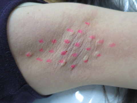 IMG_0601-脇汗ボトックス