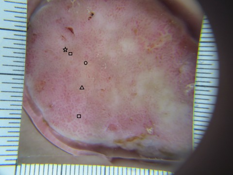 IMG_2661-50エクリン腺孔腫-m