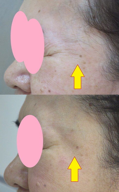 目尻ボトックス