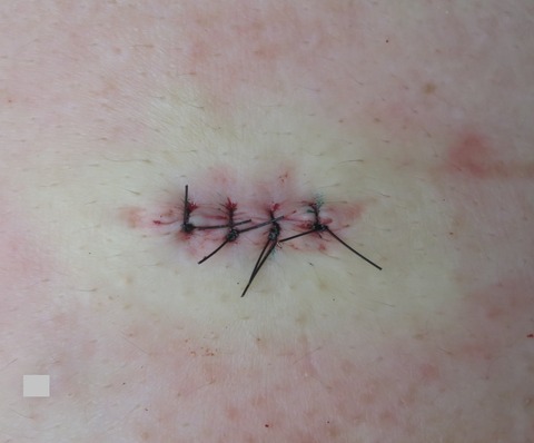 IMG_9426-11月17日左胸粉瘤-縫合