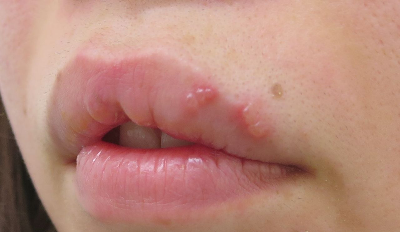 ヘルペス 口唇 口唇ヘルペスを早く治す！控えた方がいい食べ物と効果的な食べ物とは？
