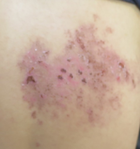 IMG_5348-帯状疱疹背中の痂疲1週間後の水疱