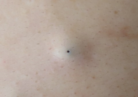 IMG_9408-11月17日左胸粉瘤-0