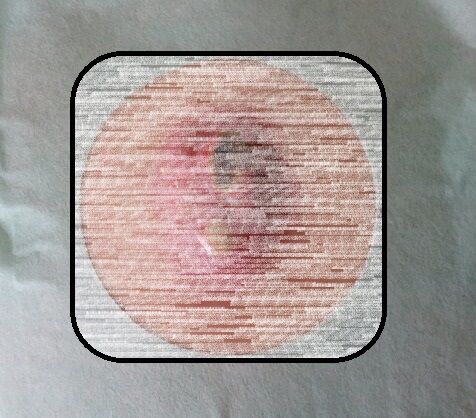 破裂後炎症性粉瘤マスクブログ