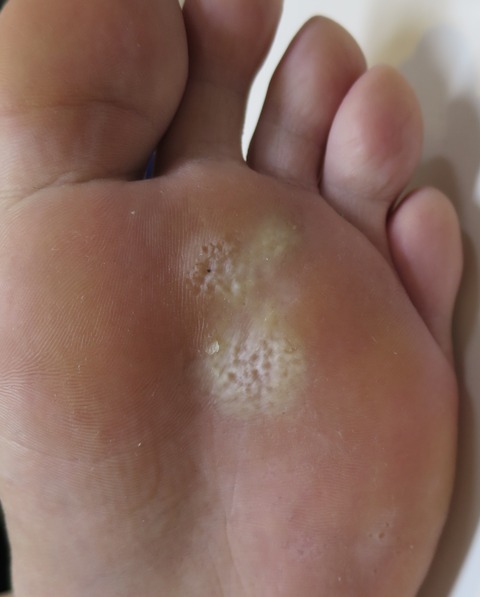 IMG_3190-点状角質融解症