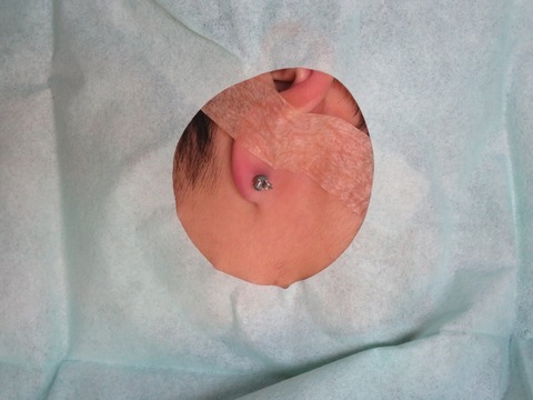 IMG_1486-ピアス埋没