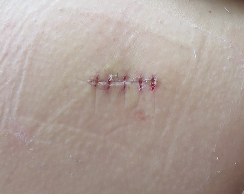 IMG_5163-t-d15抜糸