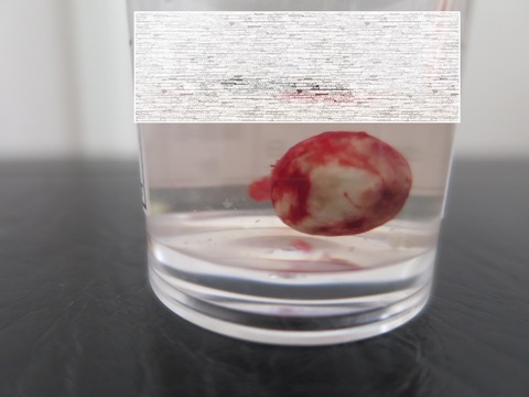 IMG_9430-11月17日左胸粉瘤-検体