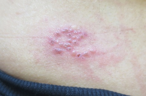 IMG_6898-t50帯状疱疹