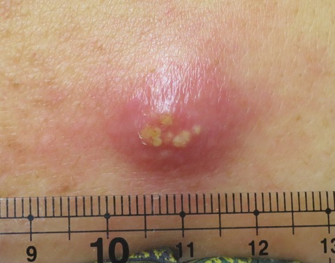 IMG_5060粉瘤3月